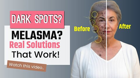 Melasma & Hyperpigmentation Treatment | Melanin Control Tips | Dark Spot Removal Skincare