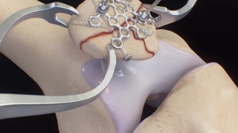Patella Fracture Repair 3D Animation (Arthrex Mesh)
