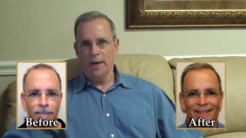 Dr. Brett Bolton Corrective Hair Transplant | MaxHarvest Plus™ Results