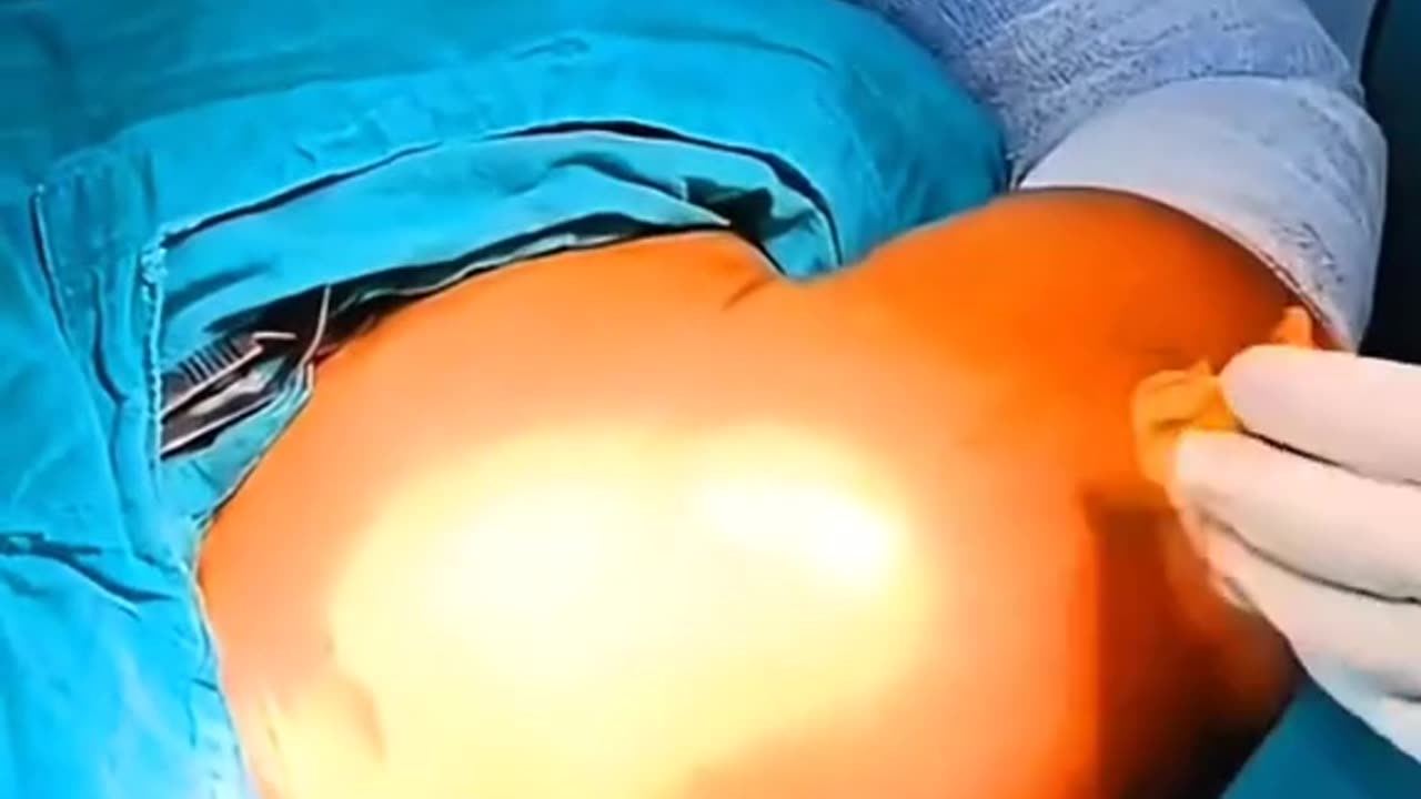 Broken Collarbone Watch How Surgeons Fix Clavicle Fractures with Titanium Plates