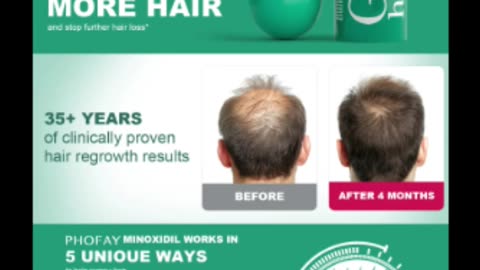 “CH004 Minoxidil Anti-Hair Loss Mousse – Regrow Stronger, Healthier Hair 💪🧴”