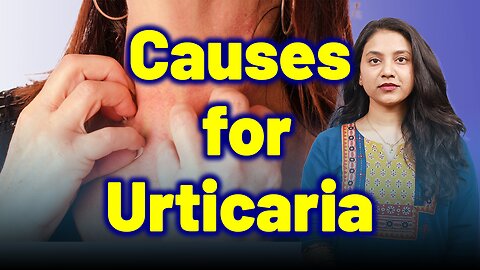 Main Causes for Urticaria, Nettle rash, Hives, Wheals .| Treatment Cure | Skin Allergy, food Allergy