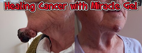 Proof of Cancer Healed by High Frequency?