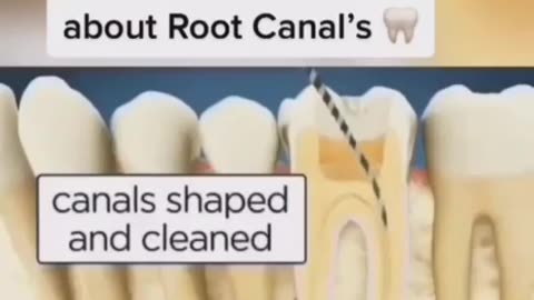 ROOT CANALS