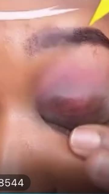 21 shows off her black eye she got from Droski