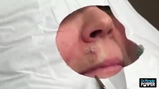 Can you spot this Blackhead Extracted on the Upper Lip