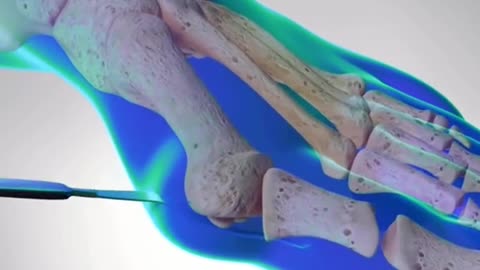 How Bunion Is Treated Bunionectomy Surgery (3D Animation)