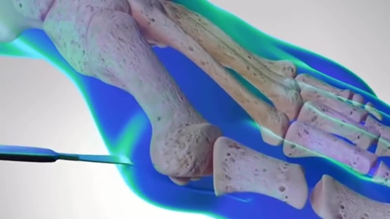 How Bunion Is Treated Bunionectomy Surgery (3D Animation)