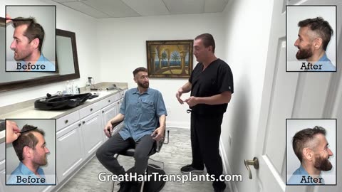Patient Mike’s Corrective Hair Transplant After a Botched FUE Procedure