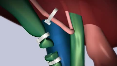 Laparoscopic Cholecystectomy Surgery 3D Animation