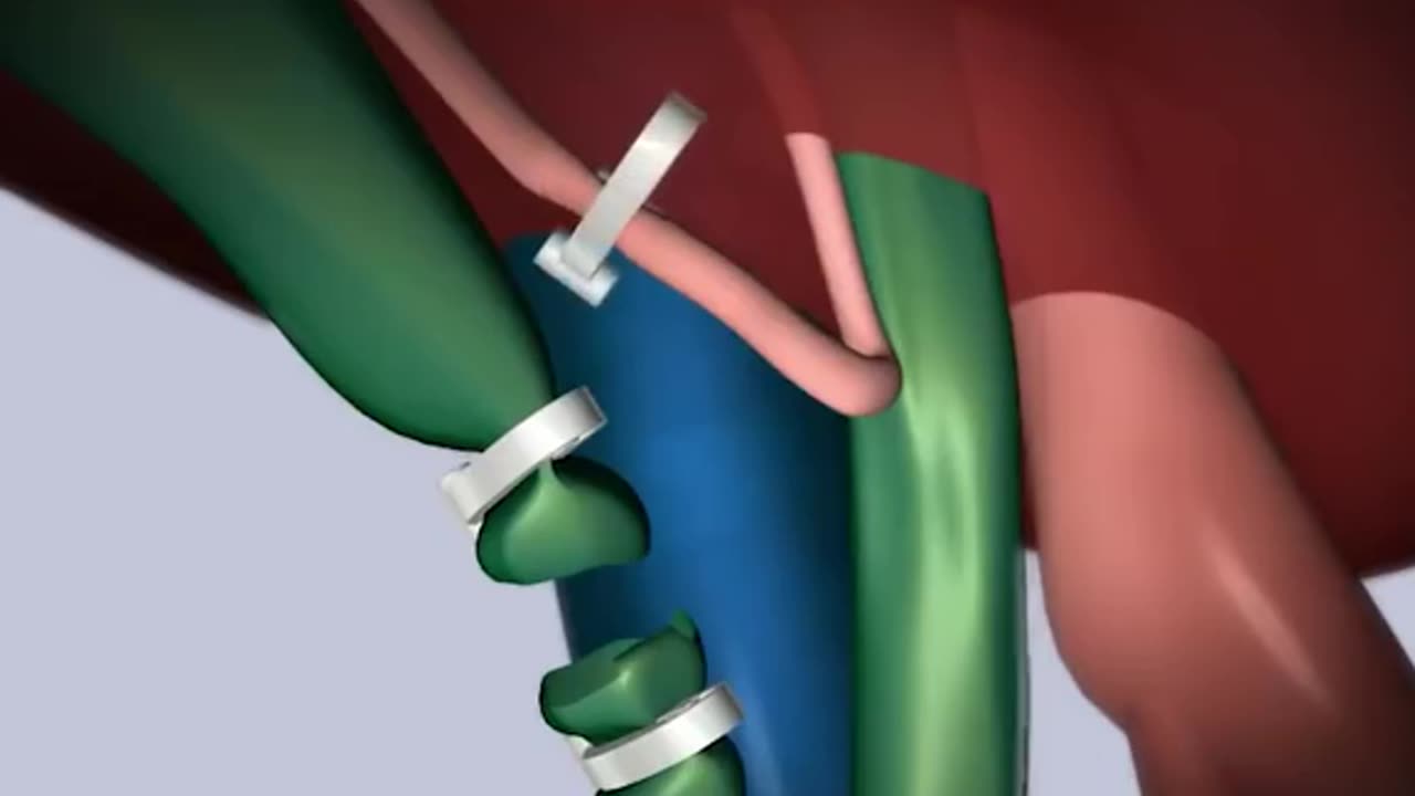 Laparoscopic Cholecystectomy Surgery 3D Animation