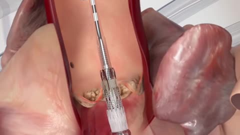 Heart Aortic Valve Replacemnt Procedure 3D Animation