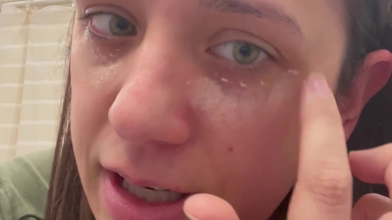 How to Finally Get Rid of Dark Under Eye Circles