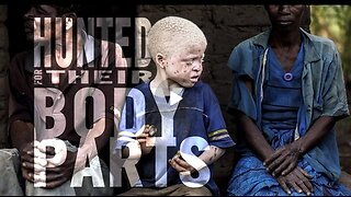 African Albinos Hunted For Their Body Parts