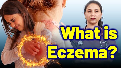 What is Atopic Dermatitis Eczema ? | Treatment Cure Relief Medicine | Skin Hair Nail | Homeopathy