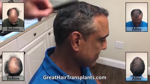 Top Hair Loss Treatment Specialist in Enid, OK for Men and Women – Promo