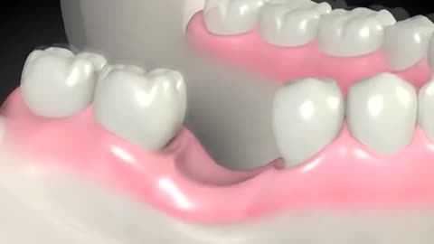 Dental Bone Graft Procedure 3D Animation