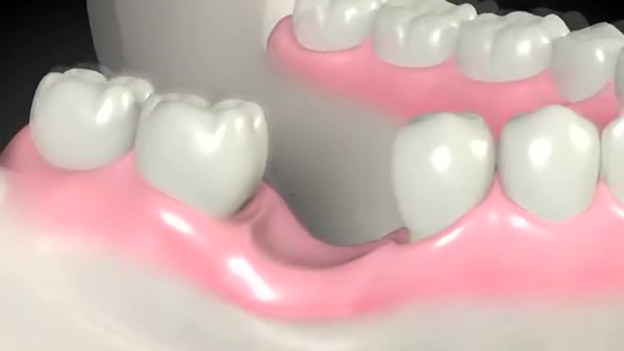 Dental Bone Graft Procedure 3D Animation