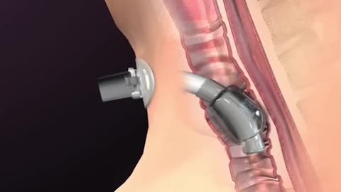 Tracheotomy Procedure 3D Animation