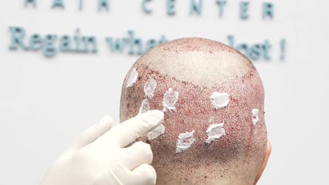 It’s so important to take care of yourself after a hair transplant!