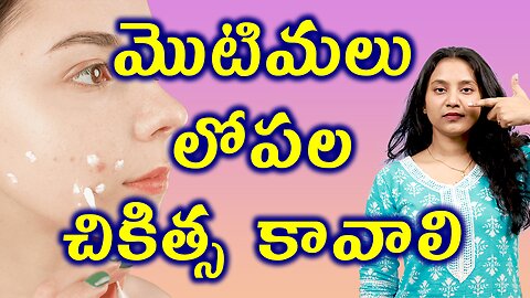 మొటిమల లోపల చికిత్స కావాలి Why Homeoapthy Treatment is Best For ACNE or Pimples Cure? | హోమియోపతి