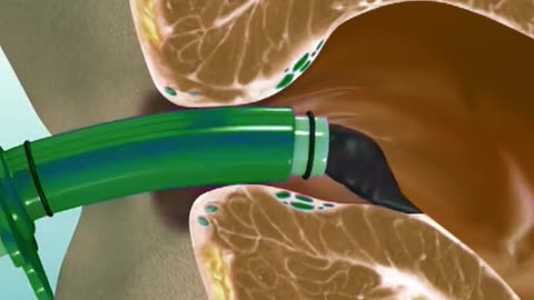 Rubber Band Surgery For Piles Treatment (3D Animation)