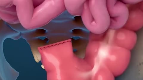 Rectum Removal Surgery 3D Animation