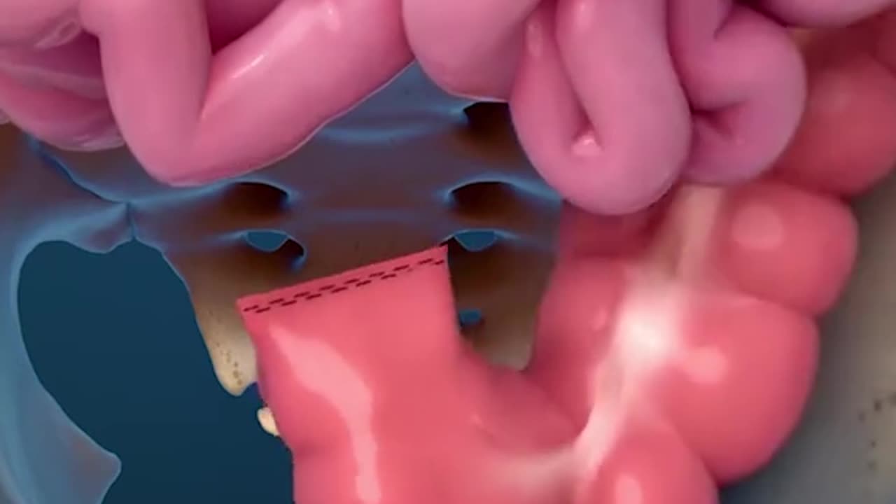 Rectum Removal Surgery 3D Animation
