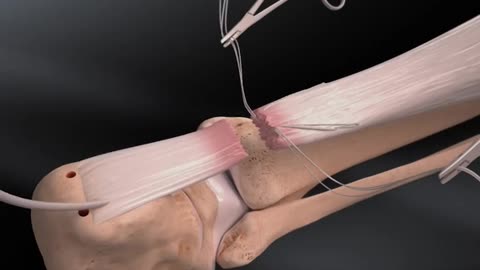 Achilles Injury Treatment 3D Animation