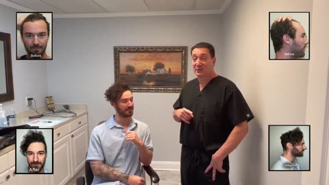 Patient Casey’s Corrective Hair Transplant After Failed FUE