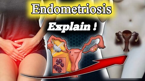 "Struggling with Endometriosis? Learn How to Take Control Today!"