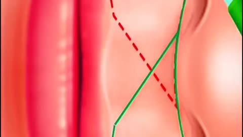 Want a Natural-Looking Smile Here’s How Lip Lift Surgery Works!