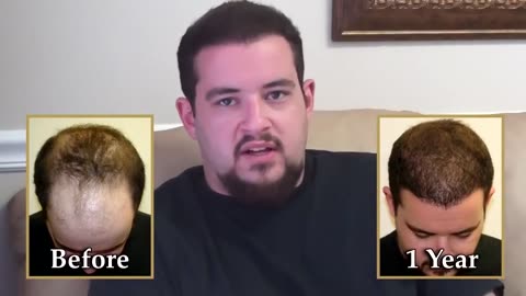 Outrageous Hair Transplant Transformation by Dr. Brett Bolton