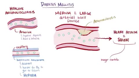 Diabetes mellitus (type 1, type 2) & diabetic ketoacidosis (DKA)