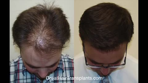 Amazing Hair Restoration Result from Dr. Brett Bolton’s MaxHarvest™ Technique