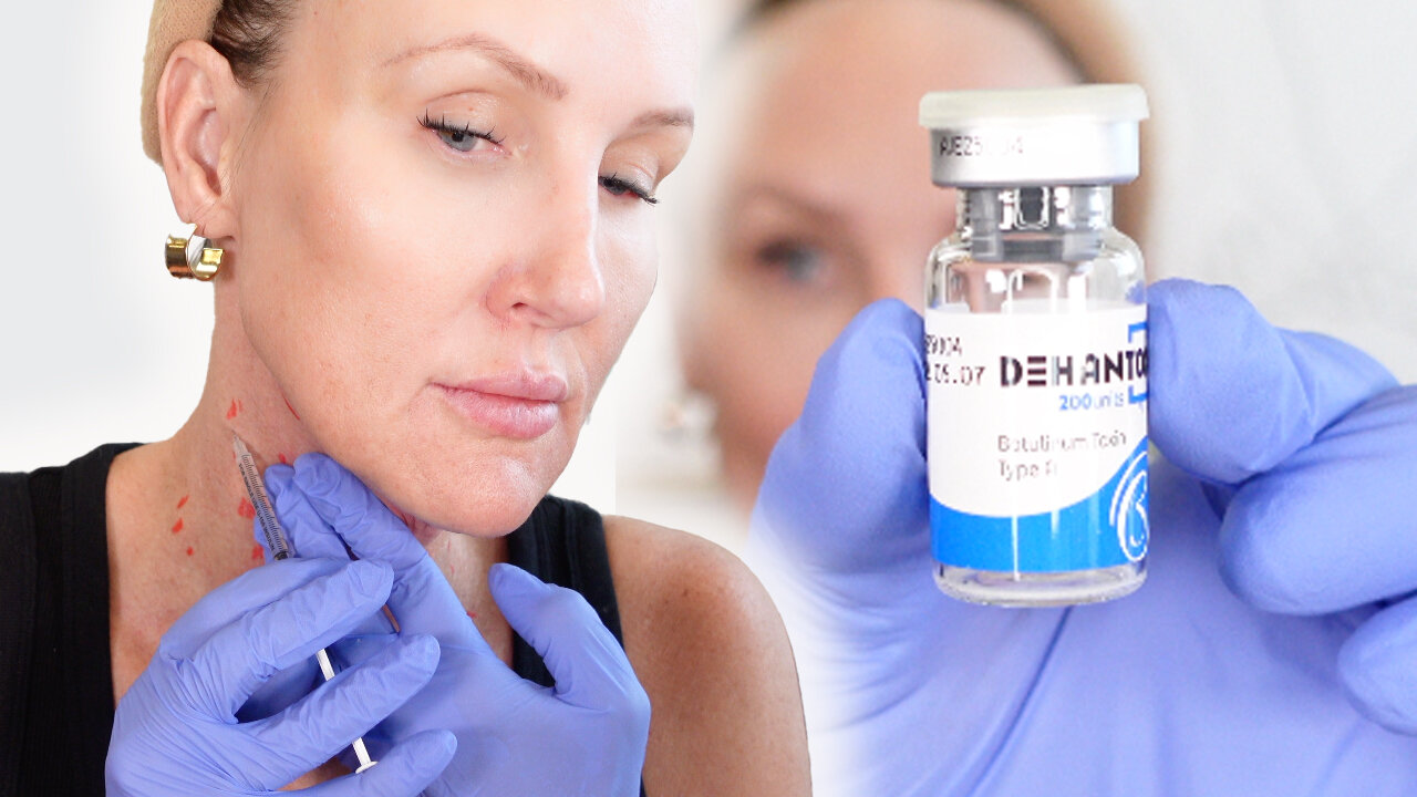 Neck Lift Demo - Dehantox 200u - Acecosm.com discount code STACY10