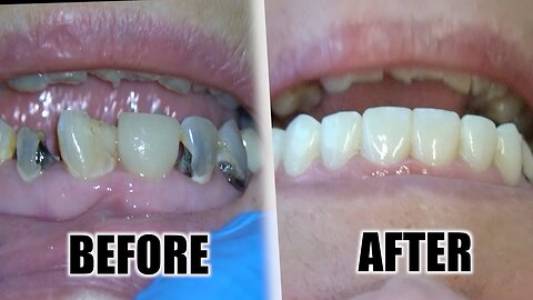 Dentist : That's How To Stop Bleeding Gums and Get Rid of Teeth Cavities