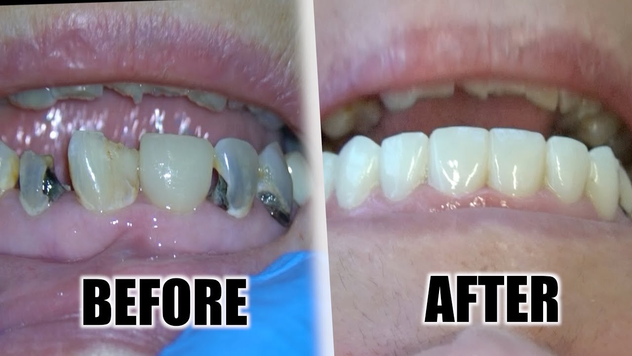 Dentist : That's How To Stop Bleeding Gums and Get Rid of Teeth Cavities