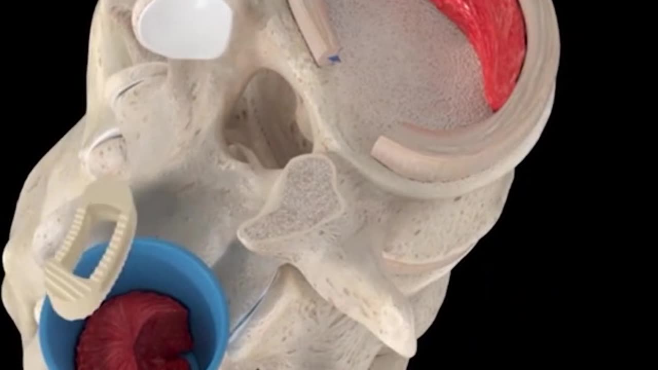 Lumbar Interbidy Fusion 3D Animation