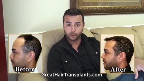 Best Hair Transplant Solutions for Men & Women in Pleasanton, CA – Promo