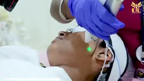 "Fotona Laser: The Ultimate Long-Term Solution for Permanent Facial Hair Reduction."