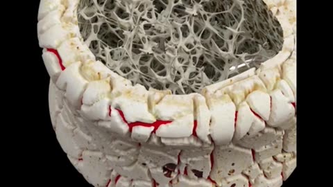 Vertebroplast Procedure 3D Animation