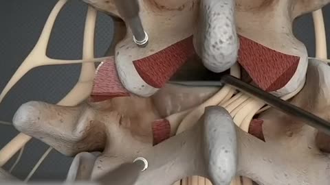 Removing Herniated Disc Surgery 3D Animation