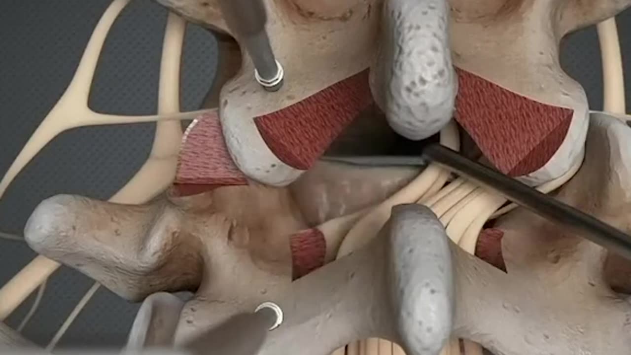 Removing Herniated Disc Surgery 3D Animation
