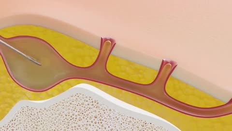 Pilonidal Cyst Treatment 3D Animation