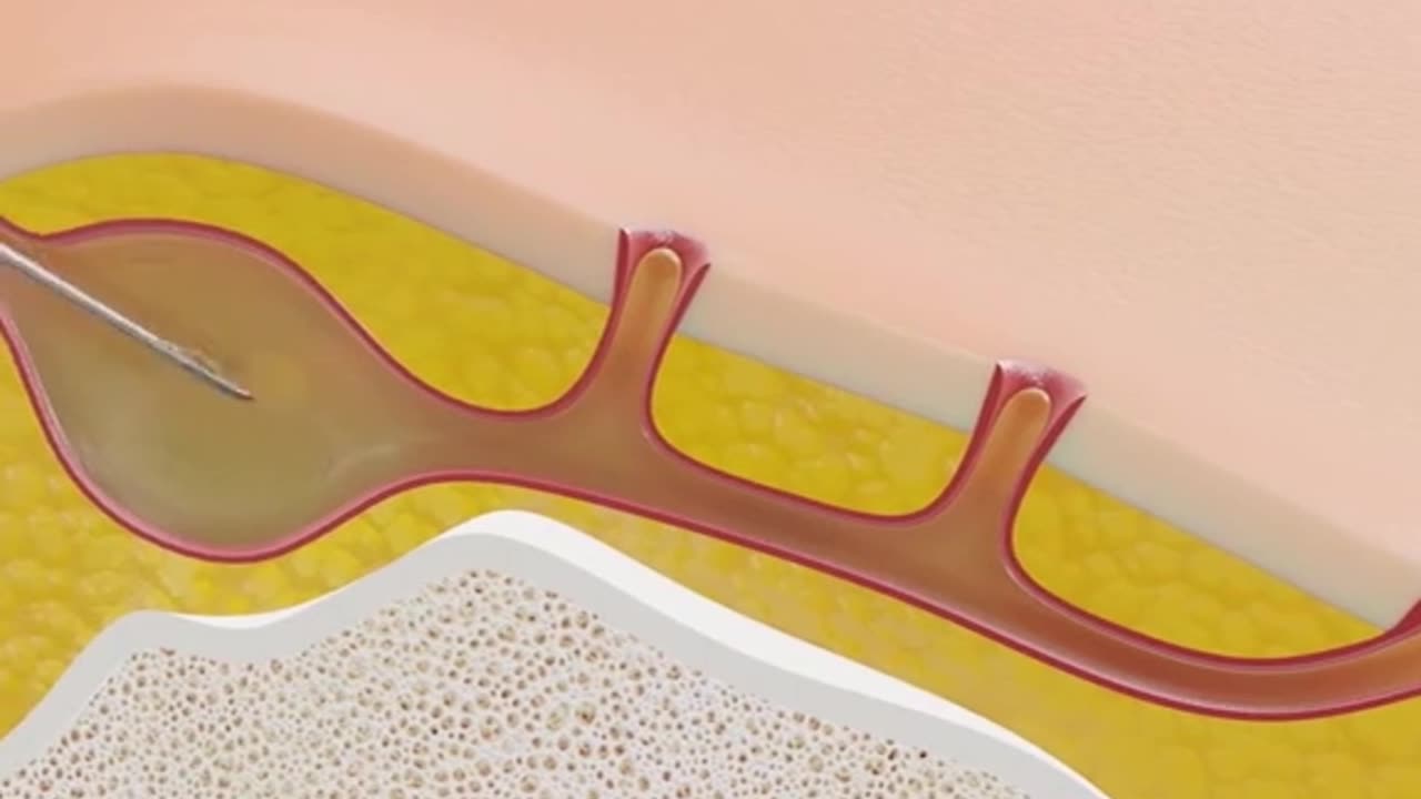 Pilonidal Cyst Treatment 3D Animation