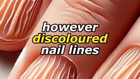 Seven things your nails can tell You about your health ! Must watch !