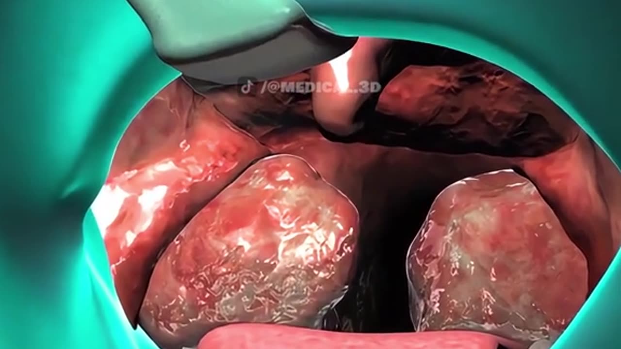 Tonsillectomy Procedure (3D Animation)