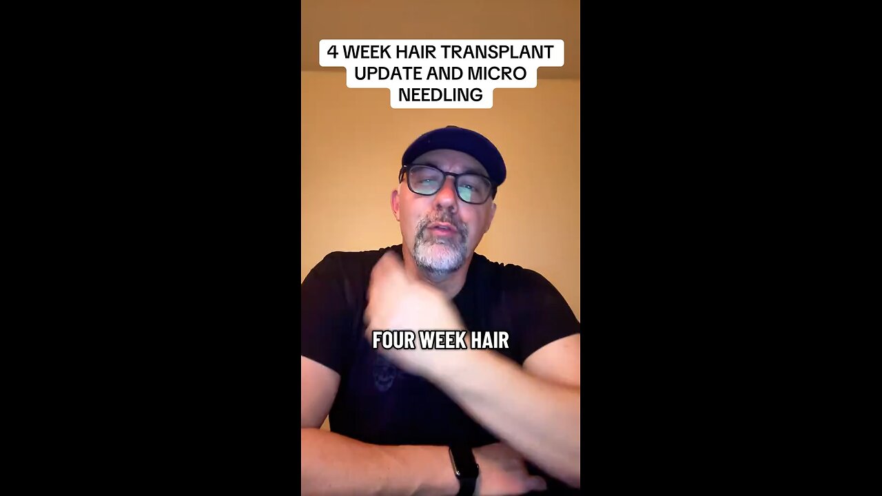 4 Week Hair Transplant Update