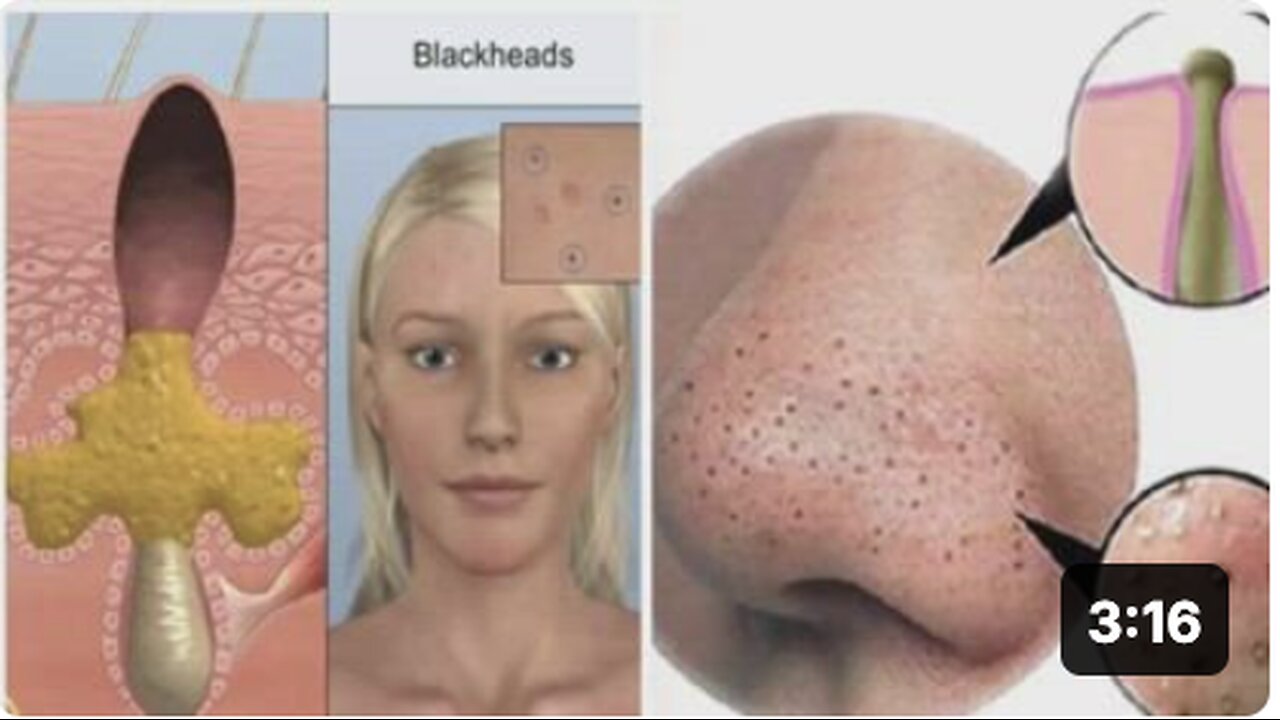 How to Remove Blackhead On Face Easy, 7 Natural Remedies Cleansing to Remove Blackheads